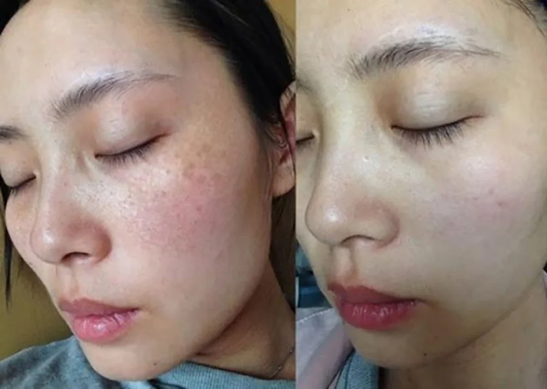 Da bị nám phải làm sao để không chỉ điều trị khỏi mà còn phòng ngừa tái phát sau điều trị rất quan trọng.