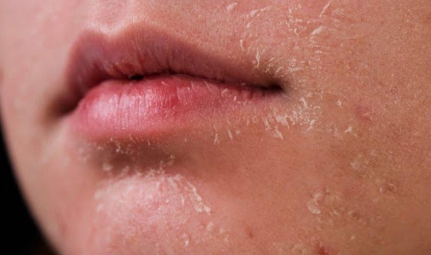 Da bong tróc khi giao mùa chủ yếu bắt nguồn từ sự thay đổi thời tiết hanh khô