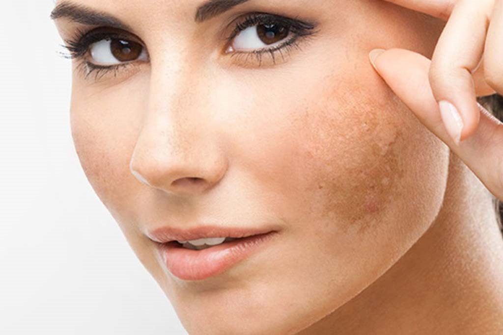 Để biết da mặt bị nám phải làm sao, bước đầu tiên là cần hiểu rõ các nguyên nhân dẫn tới tình trạng này.
