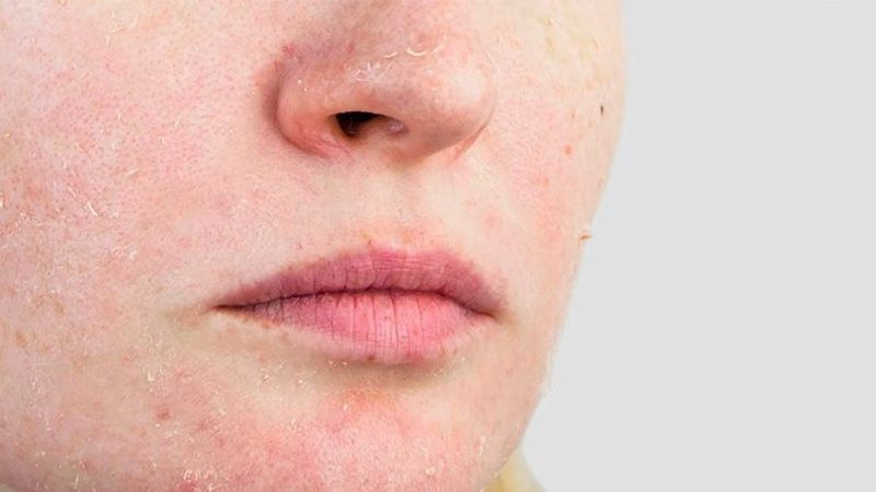 Không chỉ thay đổi không khí, sự chuyển đổi mùa khiến da nhạy cảm thời tiết mùa thu