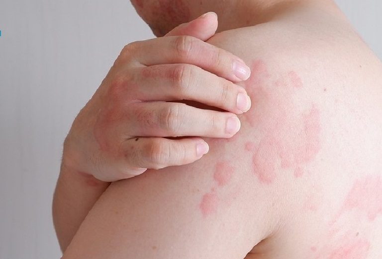 Da nổi mẩn khi giao mùa do nhiều nguyên nhân khác nhau