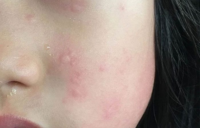 Biểu hiện rất dễ nhận biết khi da yếu khi giao mùa đó là sự thay đổi rõ rệt về bề mặt da