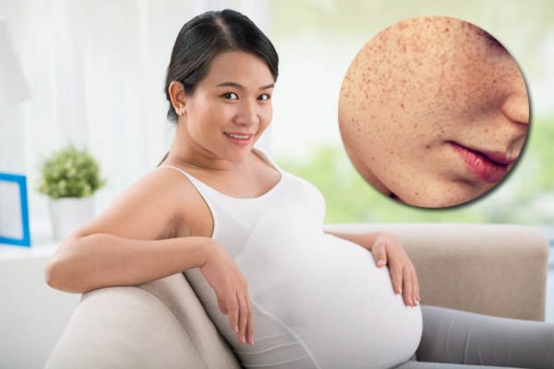 Nám da khi mang thai xảy ra phổ biến do sự thay đổi hormone progesterone và estrogen trong thời kỳ này.