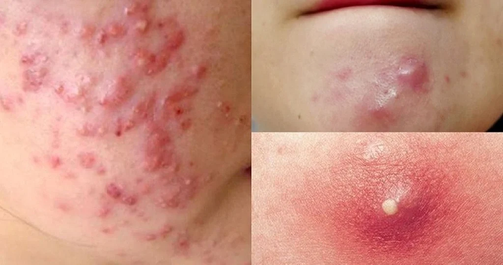 Hiểu rõ những nguyên nhân gây mụn bọc