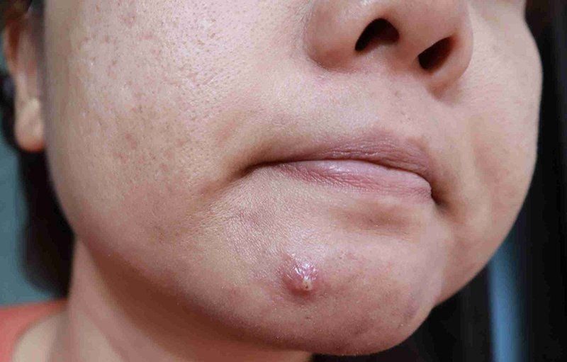 Mụn bọc mủ thường xuất hiện nhiều ở vùng mặt, cổ và lưng do sự tập trung của tuyến bã nhờn ở các khu vực này.