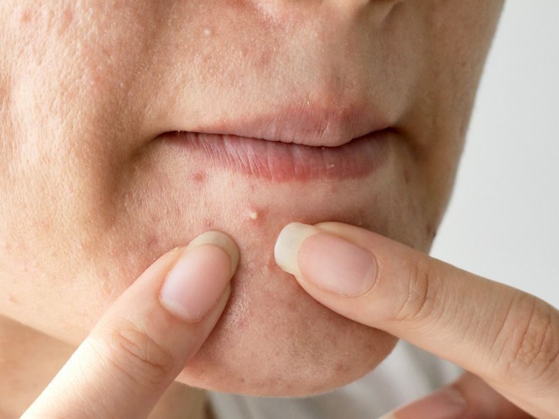 Định kỳ làm sạch sâu cho da tại cơ sở uy tín cũng là biện pháp hỗ trợ cải thiện tình trạng da mụn và phòng tránh mụn mới quay trở lại.