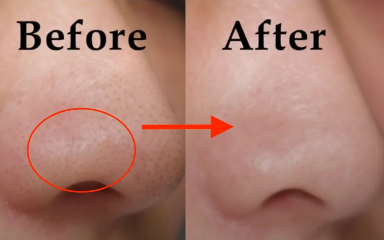 Cải thiện tình trạng mụn đầu đen ở mũi với sản phẩm Dr.Spiller
