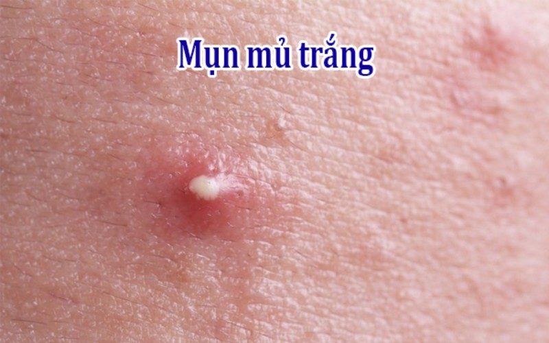 Mụn mủ trắng hình thành do nguyên nhân nào?