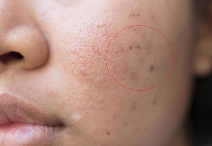 Lưu ý trong quá trình điều trị mụn thâm đen