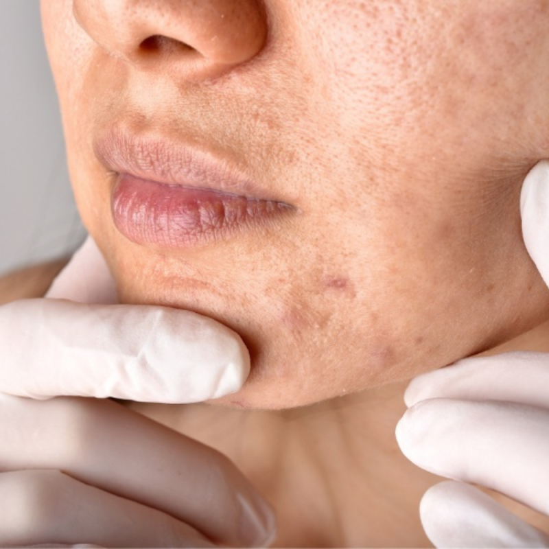 Mụn thâm đen là vùng da sậm màu sau khi mụn đã lành, không còn viêm đỏ hay sưng tấy nhưng để lại vết đen trên bề mặt.