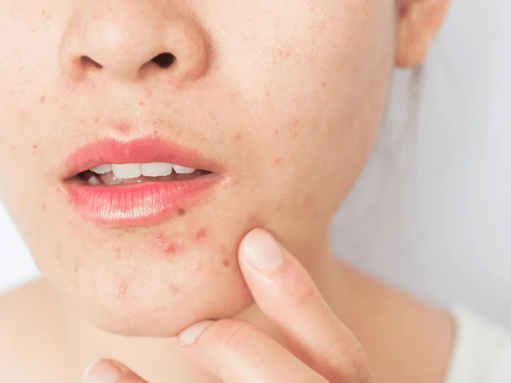 Mụn trứng cá hình thành do nhiều yếu tố kết hợp liên quan đến nội tiết tố, tuyến bã nhờn hoạt động mạnh và tác động từ môi trường.