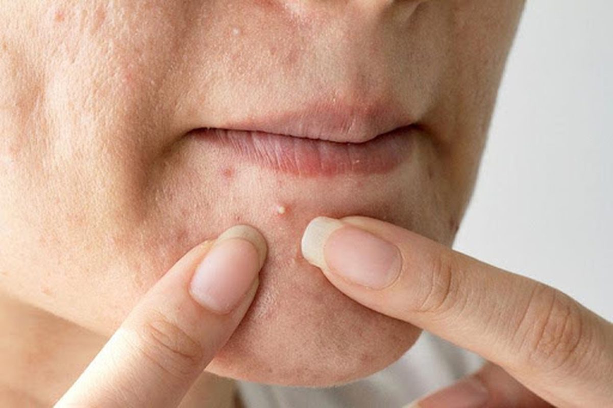 Không nên tự ý nặn hoặc gãi lên mụn trứng cá để tránh làm tổn thương da, tăng nguy cơ viêm nhiễm và sẹo.