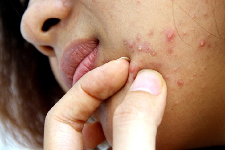 Mụn trứng cá bọc thường xuất hiện dưới dạng các nốt lớn, sưng đỏ, có thể gây đau nhức rõ rệt.