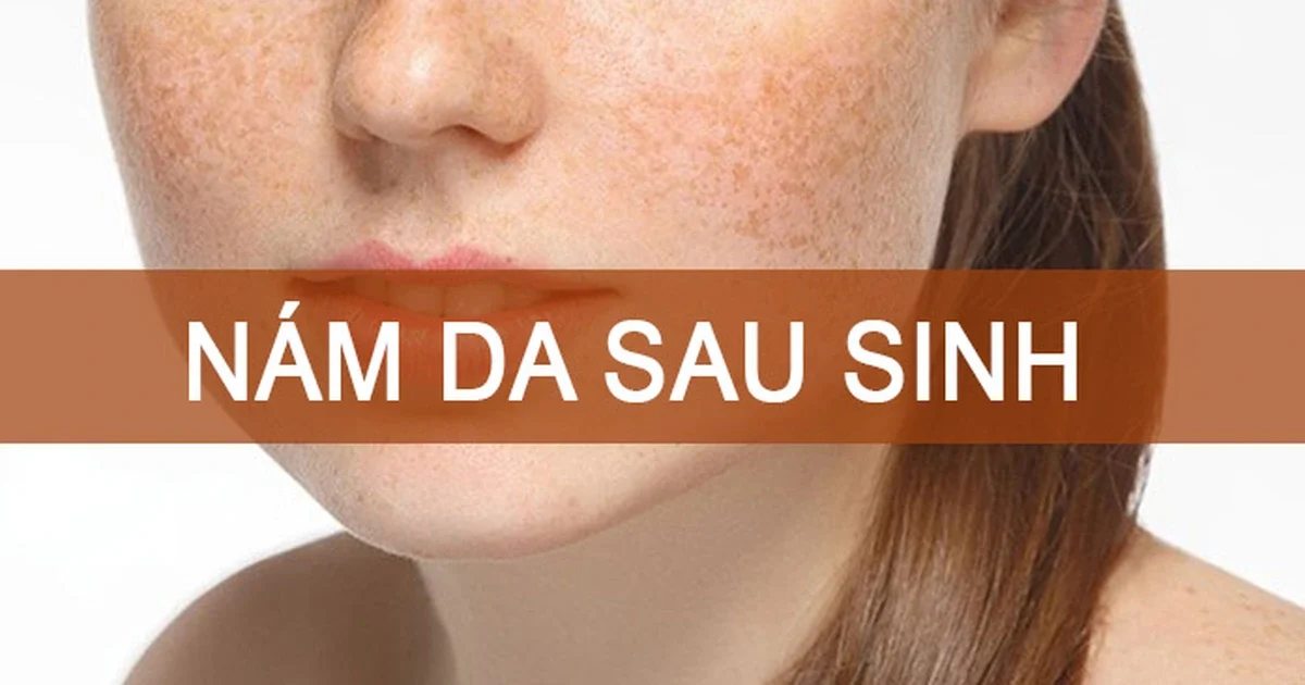 Nám da sau sinh chủ yếu bắt nguồn từ sự thay đổi hormone estrogen và progesterone trong cơ thể người mẹ.