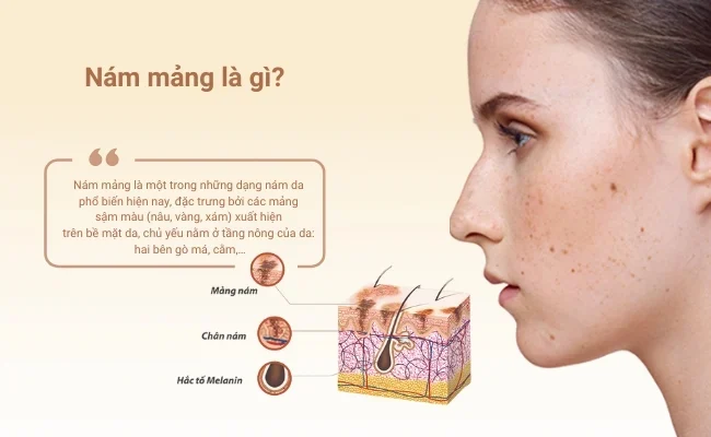 Hiện nay, nhiều sản phẩm điều trị nám mảng được cải tiến để vừa dưỡng da vừa giúp đẩy lùi sắc tố melanin hiệu quả
