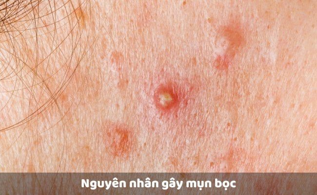 Có thể nói, nặn mụn bọc đúng cách kết hợp chăm sóc da toàn diện chính là chìa khóa vàng mang lại diện mạo tươi trẻ cho làn da.