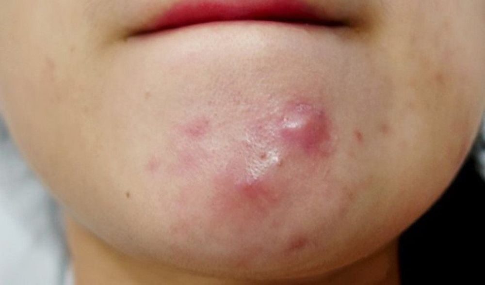 Chăm sóc da sau nặn mụn bọc với sản phẩm Dr.Spiller