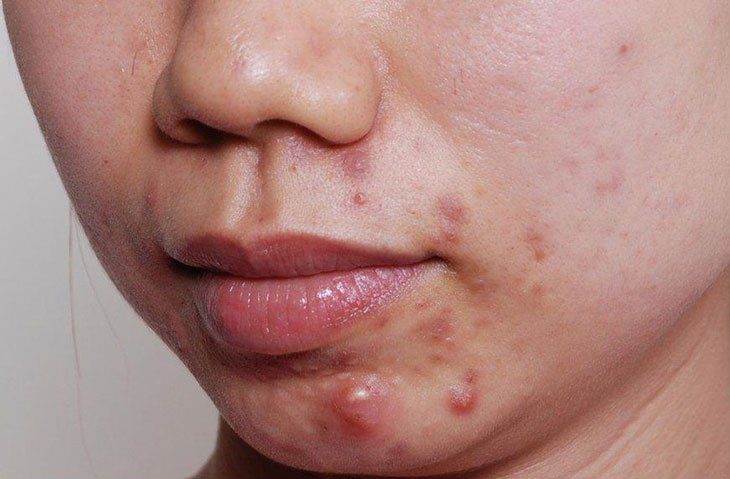Nặn mụn bọc giúp loại bỏ nhanh hạch mụn chứa mủ, từ đó ngăn ngừa lây lan vi khuẩn sang các vùng da lân cận.