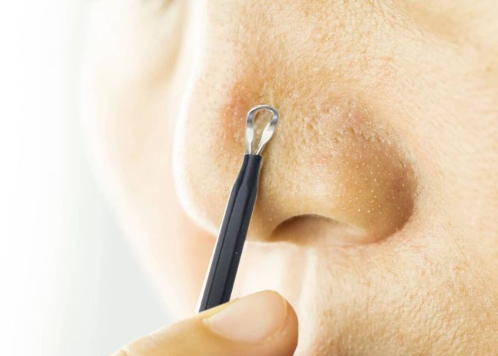 Những lưu ý sau khi nặn mụn đầu đen ở mũi