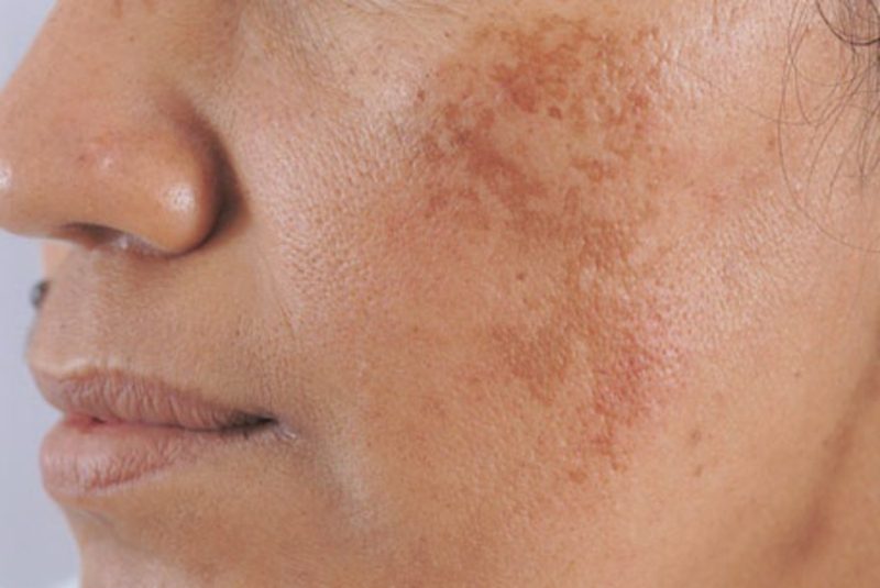 Dr-Spiller là thương hiệu chăm sóc da nổi tiếng chuyên cung cấp các sản phẩm điều trị và phòng ngừa nám da