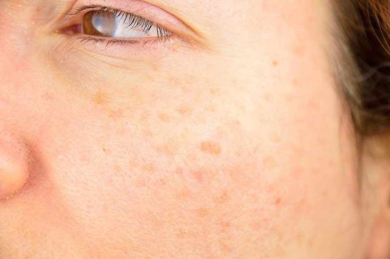 Dr-Spiller luôn là thương hiệu được đánh giá cao về hiệu quả chăm sóc và điều trị vấn đề sắc tố da, sự lựa chọn ưu tiên của nhiều khách hàng khó tính.