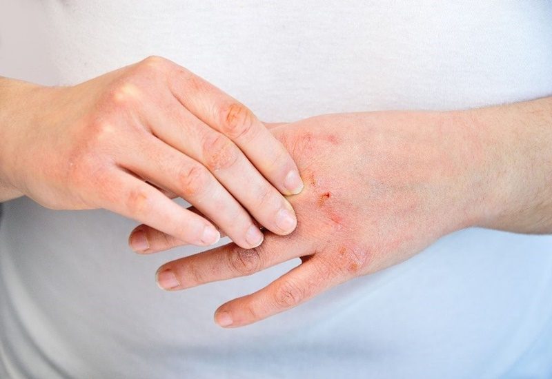 Nứt nẻ da tay mùa thu là tình trạng thường gặp mùa hanh khô