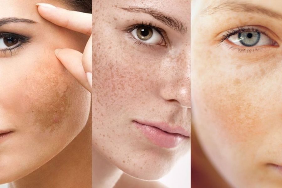 Nám chân sâu và nám mảng là hai dạng nám da phổ biến nhưng lại khác biệt rõ rệt về xuất phát điểm và cơ chế hình thành.