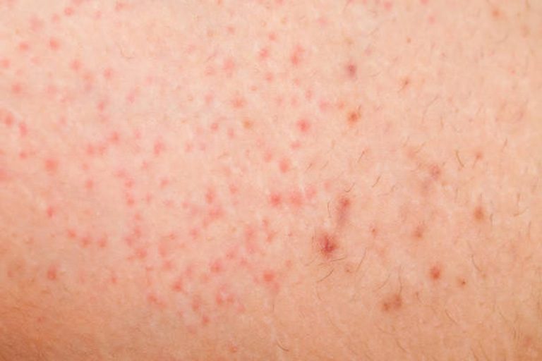 Những lưu ý khi chăm sóc da viêm nang lông