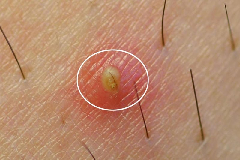 Hướng dẫn sử dụng thuốc bôi viêm nang lông vùng kín an toàn và hiệu quả