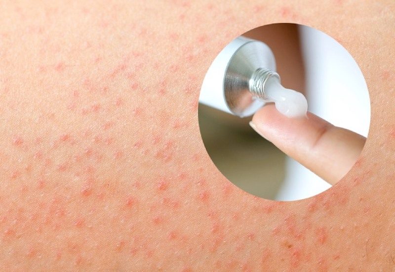 Bên cạnh thuốc trị viêm nang lông ở chân bạn có thể áp dụng cách thường xuyên tẩy da chết với sản phẩm Dr.Spiller để ngăn ngừa viêm nang lông