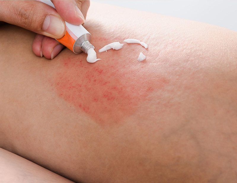 Kinh nghiệm lựa chọn và sử dụng thuốc trị viêm nang lông ở chân hiệu quả
