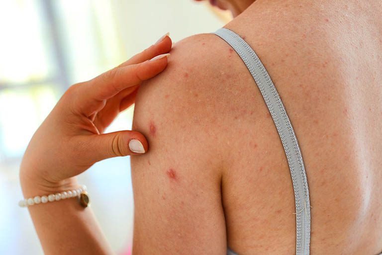 Tìm hiểu nguyên nhân để chọn loại thuốc trị viêm nang lông ở chân hiệu quả