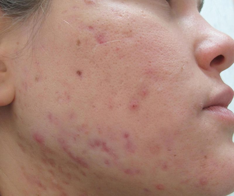 Hiểu rõ nguyên nhân để biết cách trị thâm mụn hiệu quả