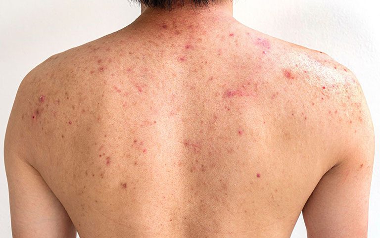Hiểu rõ nguyên nhân viêm nang lông để biết cách trị viêm nang lông tại nhà