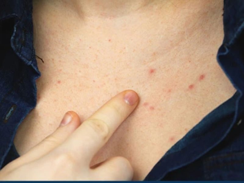 Nhận biết triệu trứng viêm nang lông?