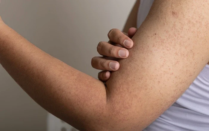 Những cách chăm sóc viêm nang lông cánh tay nào phổ biến hiện nay