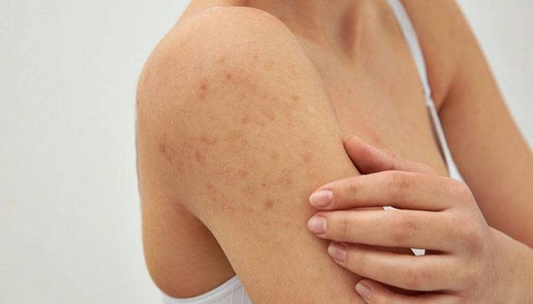 Tẩy da chết thường chuyên giúp giảm viêm nang lông hiệu quả