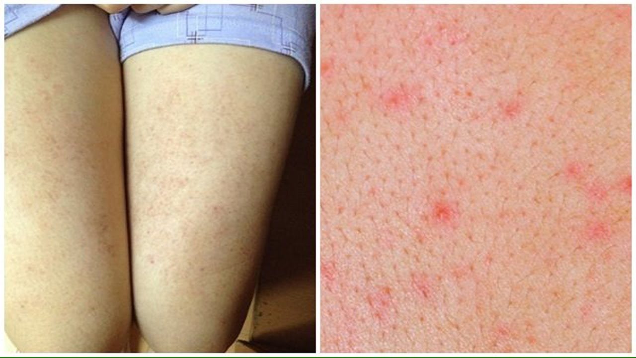 Tẩy da chết thường xuyên với sản phẩm Dr.Spiller giúp giảm viêm nang lông hiệu quả