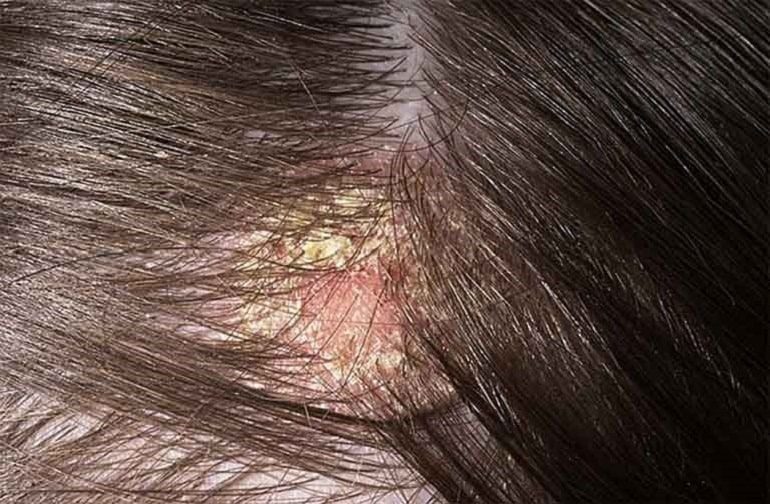 Nguyên nhân nào khiến viêm nang lông da đầu