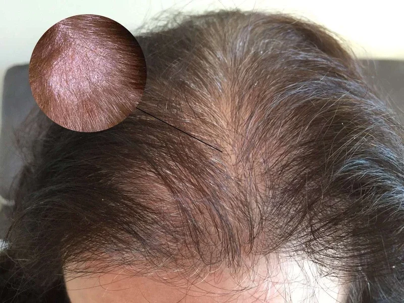 Qua đó, việc xây dựng thói quen chăm sóc và bảo vệ da đầu khoa học sẽ giúp giảm tình trạng viêm nang lông da đầu và cải thiện sức khỏe lâu dài.