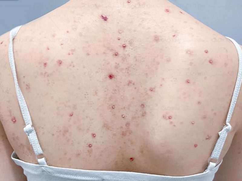 Bên cạnh đó, vi khuẩn gây viêm nang lông còn có thể dẫn đến nhiễm trùng da nặng cần được can thiệp y tế chuyên sâu để tránh biến chứng.