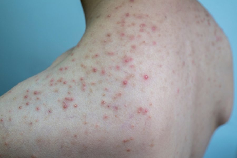 Chăm sóc, tẩy da chết thường xuyên giúp ngăn ngừa viêm nang lông lưng