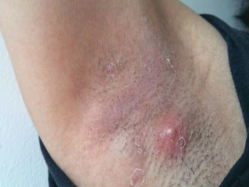 Kiên trì thực hiện chăm sóc kết hợp điều trị giúp giảm nguy cơ viêm nang lông nách tái phát và giữ cho vùng da dưới cánh tay luôn khỏe mạnh, mịn màng.