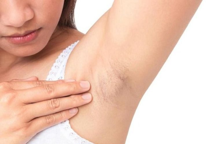 Nguyên nhân gây viêm nang lông nách là gì? Chăm sóc sao cho hiệu quả