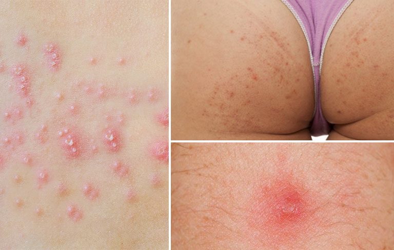 Sự kết hợp các dưỡng chất độc quyền của Dr-Spiller không chỉ cải thiện tình trạng da mà còn ngăn ngừa nguy cơ tình trạng viêm tái phát trở lại.