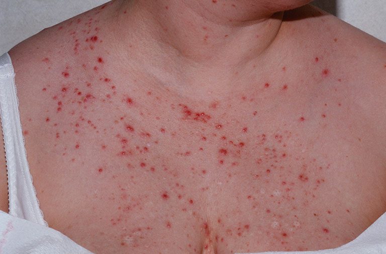 Đặc biệt cần lưu ý không dùng tay bẩn đụng vào các nốt mụn để tránh lây lan vi khuẩn