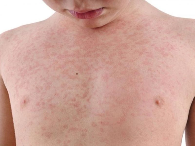 Cách chăm sóc và điều trị viêm nang lông ở trẻ em
