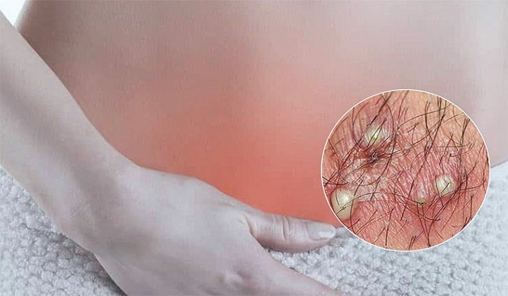 Tìm hiểu nguyên nhân nào gây viêm nang lông vùng kín