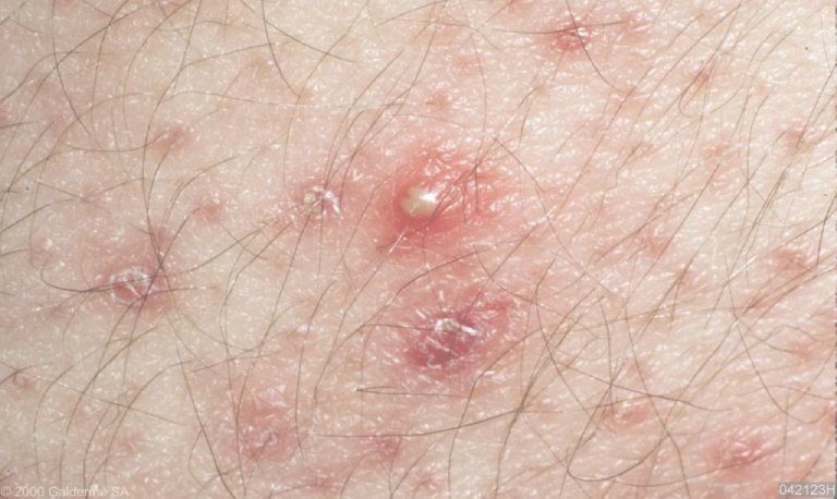 Các biện pháp phòng ngừa viêm nang lông vùng kín