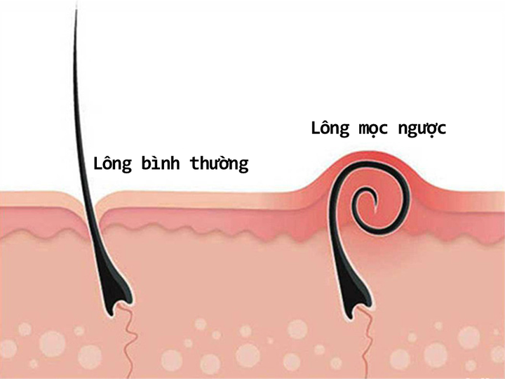 Những lưu ý khi chăm sóc da viêm nang lông vùng kín